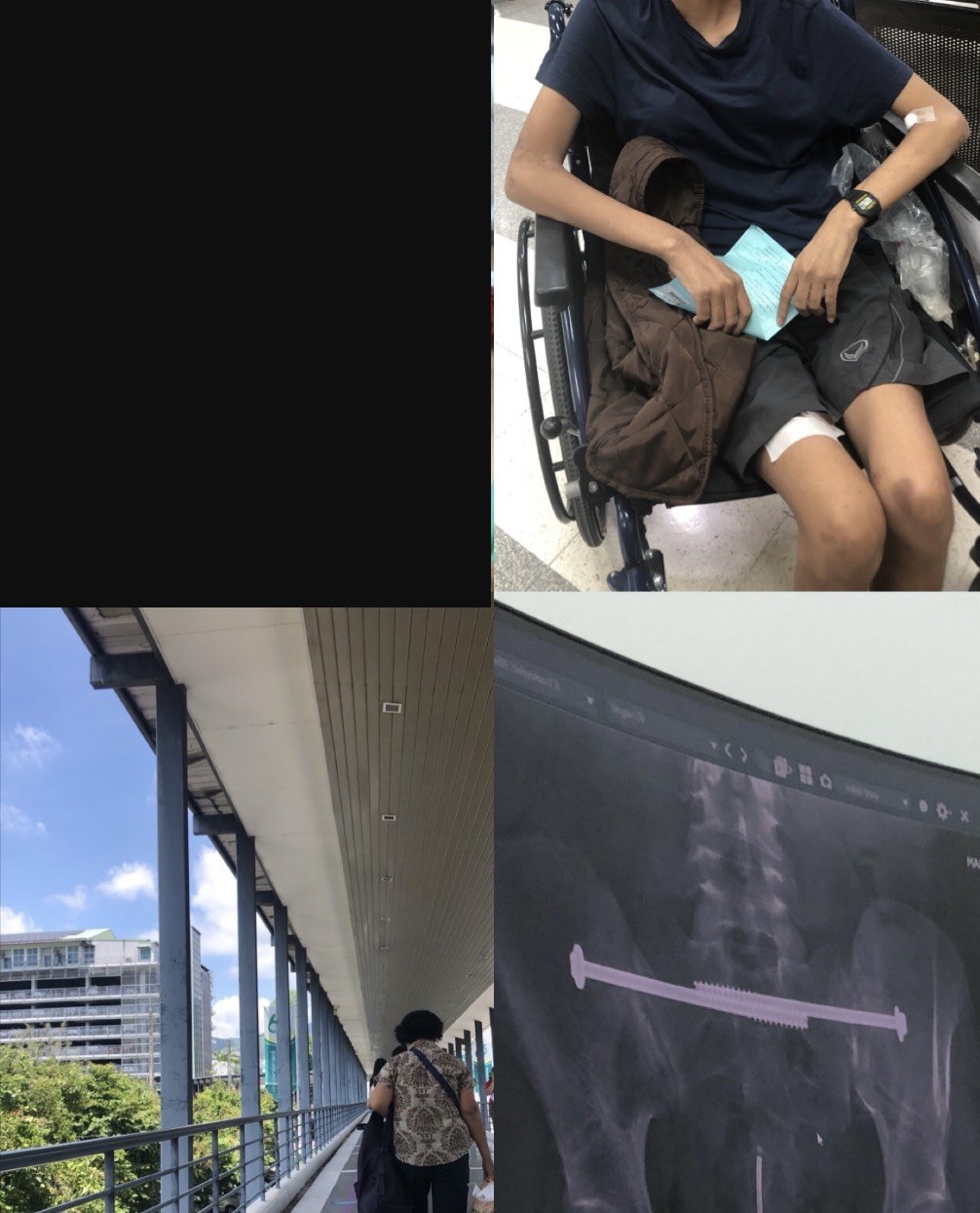 Recovery moments — in a wheelchair, on the hospital walkway, and an X-ray of the pelvic implant